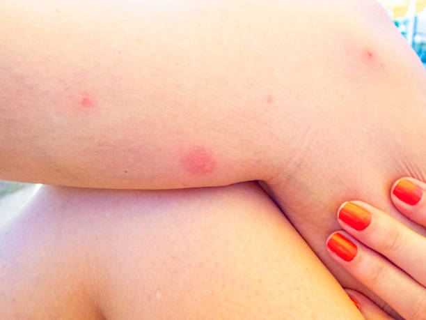 Why Professional Bed Bug Treatment Works